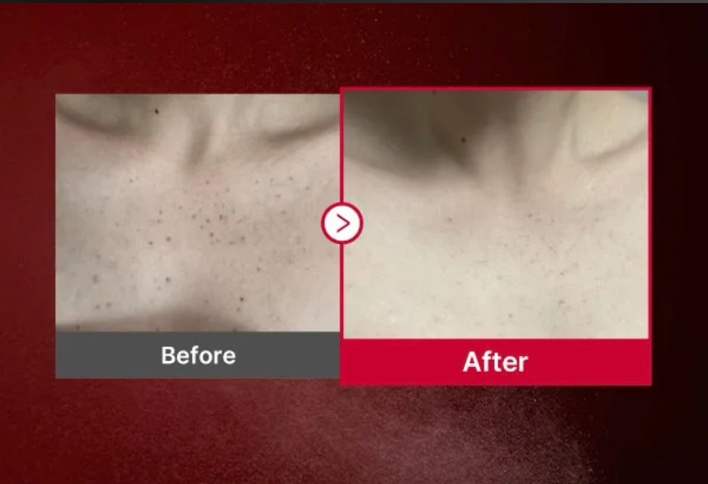 medicube - Red Acne Body Peeling Shot - Sérum exfoliant anti-acné pour le corps